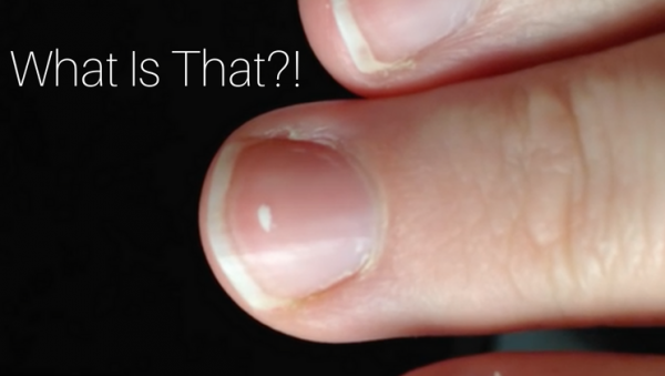 what-the-white-spots-on-your-fingernails-reveal-about-your-health